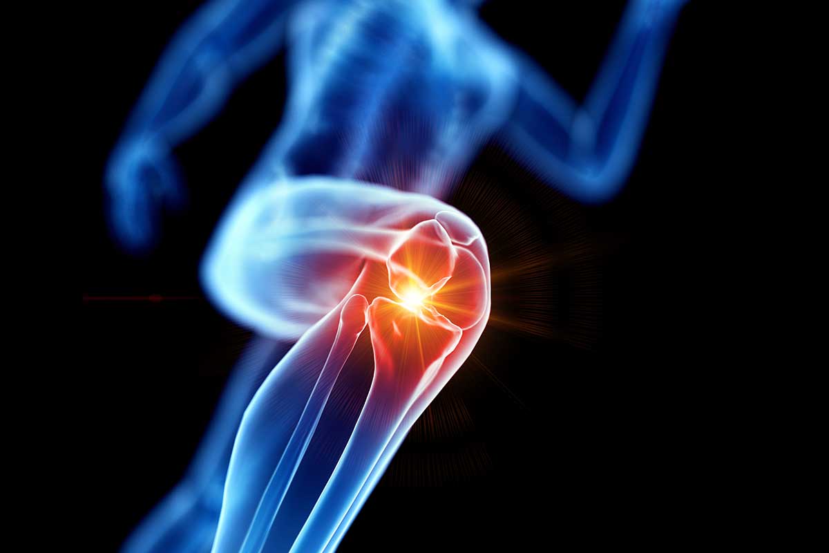 Gonarthrose (oder Knie-Arthrose): Kurze Beschreibung der Pathologie.
