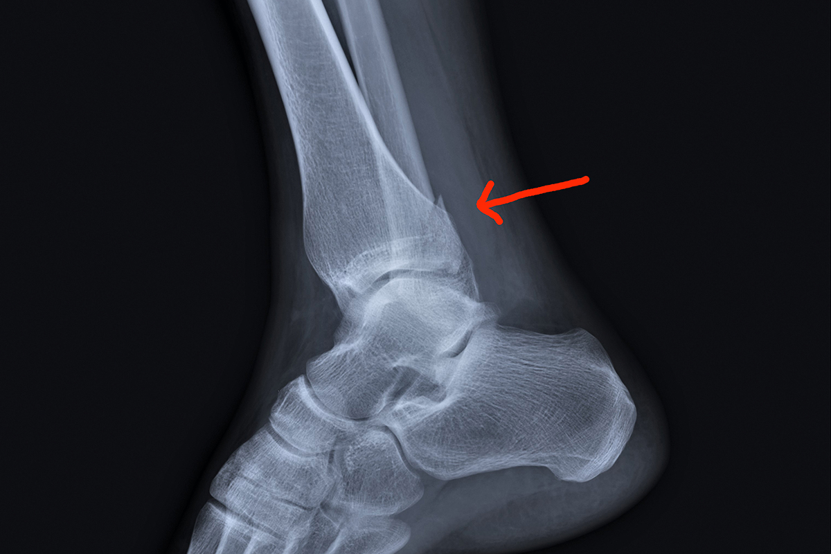 Fratture dell’estremità distale della gamba, della caviglia e del piede