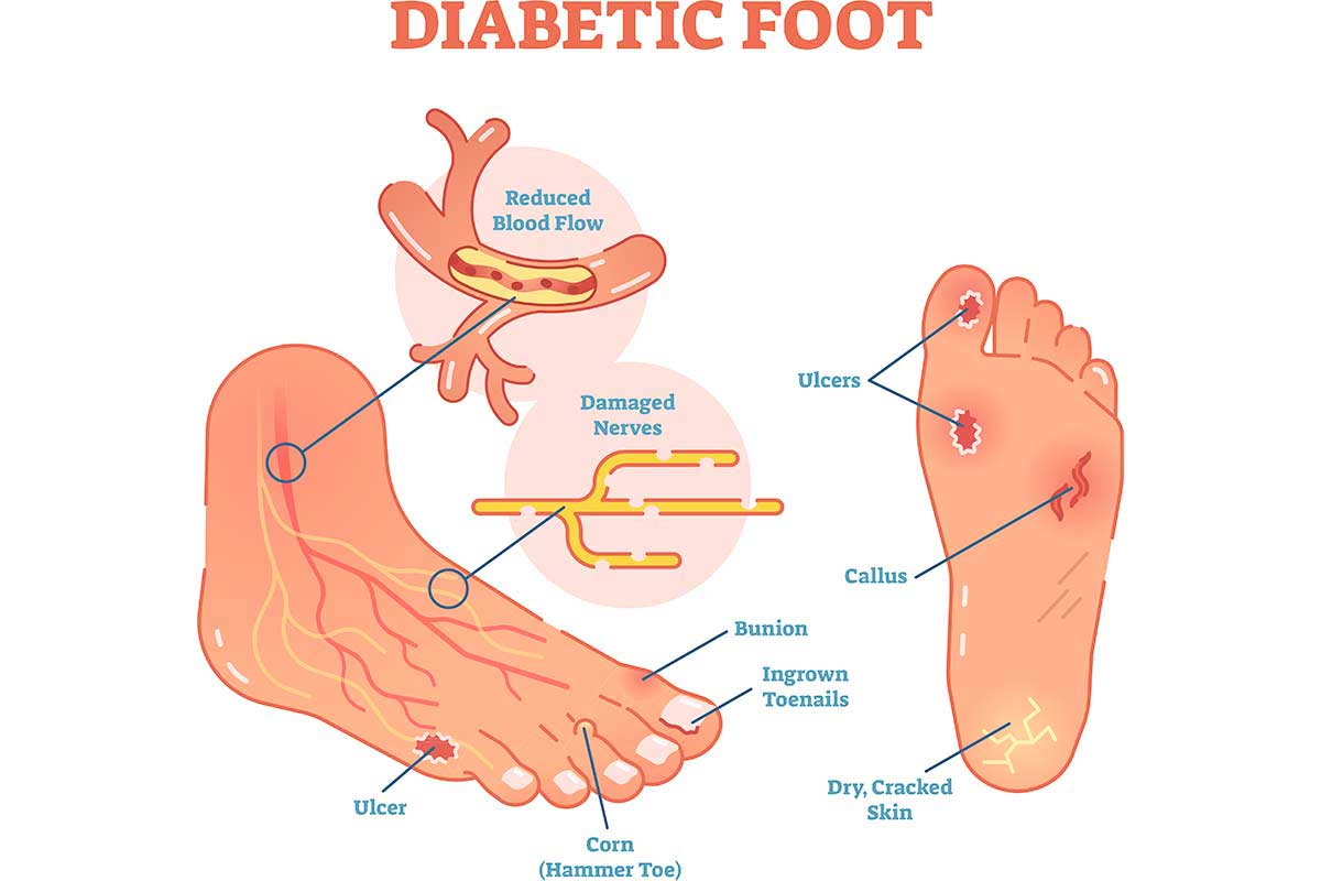 Il piede diabetico